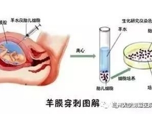 关于羊水穿刺科普