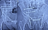 兰大二院完成甘肃省首例徒手全通道螺钉治疗骨盆前后环分离伴前柱骨折微创手术