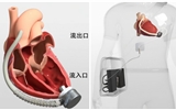 兰大二院成功实施甘肃省首例人工心脏左心辅助装置（LVAD）植入手术