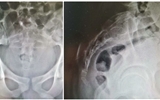 兰大二院骨科成功开展地舒单抗诱导联合微波消融术治疗高位骶骨骨巨细胞瘤