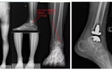 pc28预测在线预测神测网3.2骨科完成甘肃省首例INBONEII全踝关节置换手术