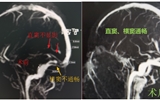 兰大二院成功救治一名罕见复杂危重的颅内感染性静脉窦血栓患儿