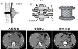 兰大二院普通外科联合消化内科使用LAMS支架完成一例胰腺假性囊肿手术