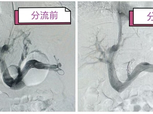 兰大二院携手基层医院成功救治高龄食管胃底静脉曲张破裂出血患者